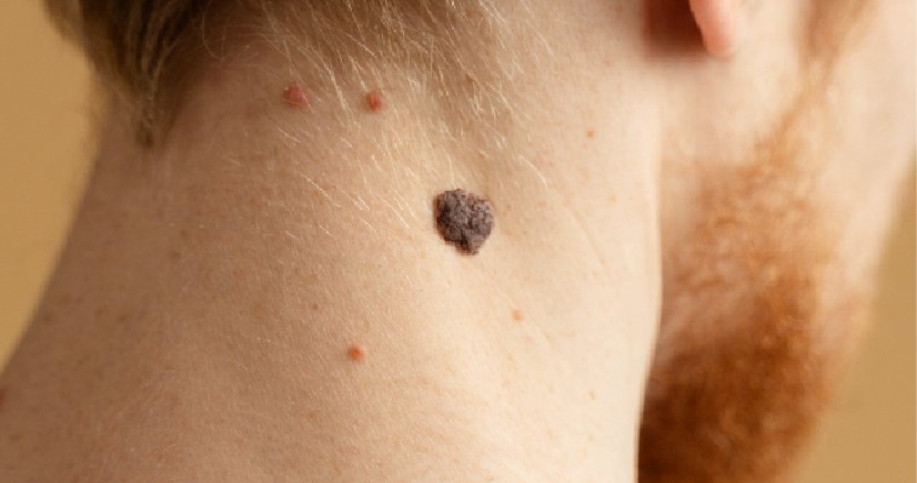 Keloid Laser Removal